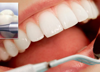 detartraj dentar in sector 2