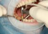 implant dentar
