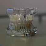proteze pe implant