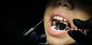 extractii dentare