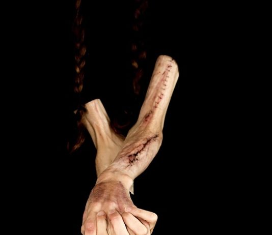 Cicatrici: ce trebuie să știi despre procesul de cicatrizare? proces cicatrici