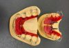 Aparat dentar ieftin